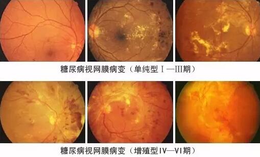 糖尿病引起的眼部并发症有很多，糖尿病视网膜病变(DR)就是其中之一，糖尿病视网膜病变是糖尿病在眼部的一种严重并发症，它对视力有很大危害，如不及时医治，可能造成失明。症状包括视力模糊、阴影、斑点及疼痛。.jpg