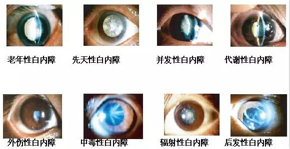 长时间在白色光亮污染环境下工作和生活的人，尤其是长时间接触过强的光线，视网膜和虹膜都会受到程度不同的损害，较终也会伤害晶状体，时间一长，就会使视力下降，使晶状体蛋白发生变性，形成混浊，发展成为白内障1.jpg