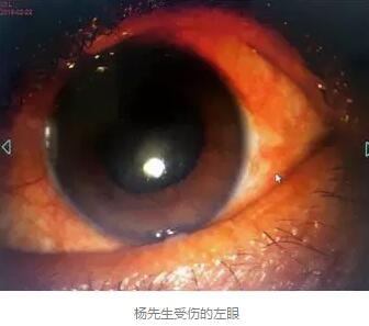 白内障和青光眼都是致盲性眼病，其中青光眼的病程不逆转。杨先生拖延伤情导致同时并发白内障、青光眼的情况，十分令人惋惜。”出名眼科专家、成都8868体育官方网站(官方)登录入口陈晓明教授表示2.jpg