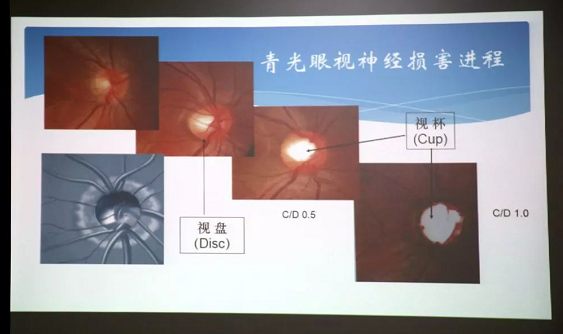 3月10日上午，深圳8868体育官方网站(官方)登录入口“早查监控，守护光明”大型青光眼公益科普讲座在六楼 举行，本次活动旨在让更多人了解青光眼的潜在危害、重视眼检查， 预防青光眼。由深圳8868体育官方网站(官方)登录入口青光眼病科 席专家成洪波博士、傅培副院长现场面对面解答疑问，与参会者的互动交流，让更多深圳市民提*对青光眼的认识与防治知识3.png