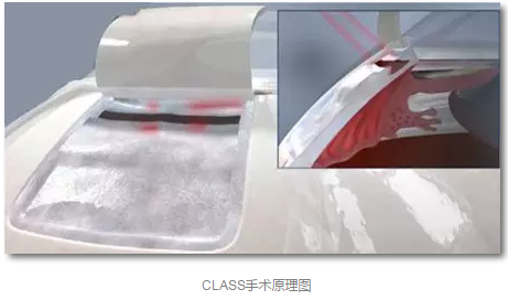 成都8868体育官方网站(官方)登录入口已经开展的青光眼手术有：引流阀 (钉)植入手术(2015年以来已200多 )，360°Schlemm's管切开术，激光CO2 辅助巩膜深层切除术，小梁切除术青(光眼)白(内障)联合手术。还有虹膜周切术、前房成形术、 虹膜复位术，睫状体冷冻术，小梁切开术和前房穿刺术等4.png