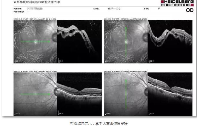 李老太在毫无征兆的情况下右眼视力下降至看不见东西。李老太家人带其至县医院就诊。医生诊断为视网膜脱离，需做玻切手术医治，而玻切手术需要动手术2次。怕疼的李老太一听就犯怵了：开刀，疼。 终，李老太的家人在多方打听后决定带李老太至宜昌8868体育官方网站(官方)登录入口找许大玲院长医治4.jpg