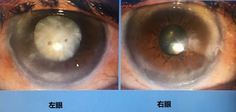 同时患 青光眼、白内障老婆婆辗转几家医院之后终于在成都8868体育网站登录入口顺利手术2.png