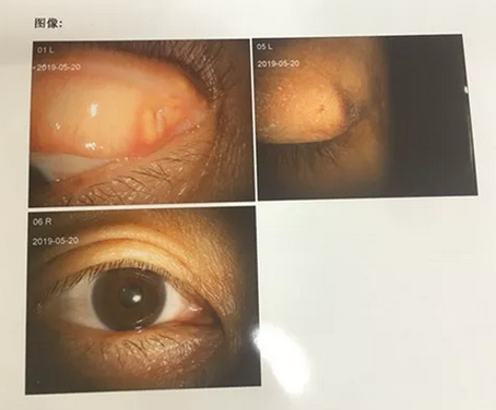 成都8868体育网站登录入口罗清礼院长为四处求医未果的河南眼眶肿瘤患者手术2.png