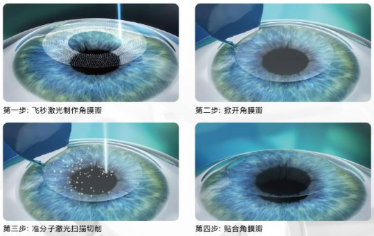 近视无法根治？但你可以这样做？8868体育网站登录入口“有爱就有希望”近视手术火热进行中5.png