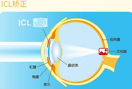 近视无法根治？但你可以这样做？8868体育网站登录入口“有爱就有希望”近视手术火热进行中8.png