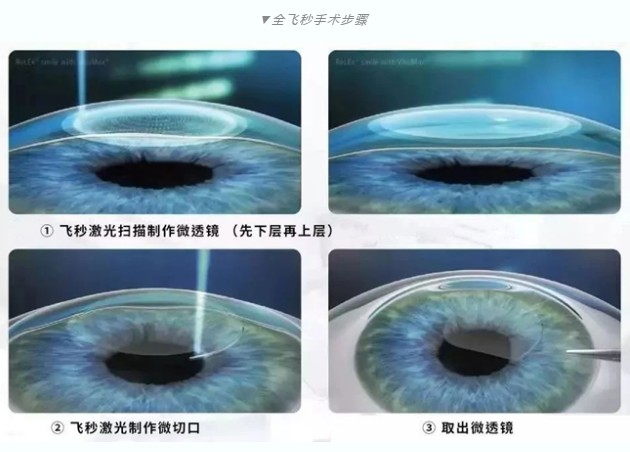 7月26日来深圳8868体育官方网站(官方)登录入口参与暑期摘镜季活动就可以有机会参与抽奖免单手术！2.png