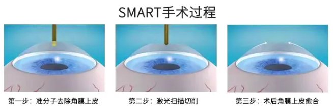 高考毕业后做近视手术，如今近视手术有了越来越高的安全性，且多样的术式可以满足不同患者的摘镜需求。2.png