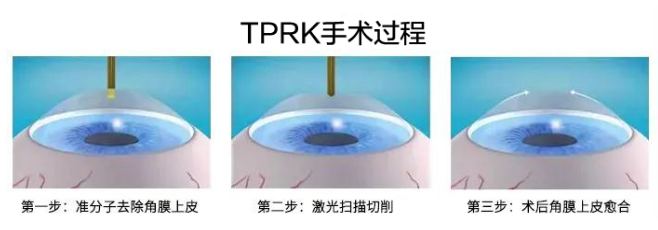 2021年征兵时间已定，参加征兵近视青年需尽快做近视手术3.png